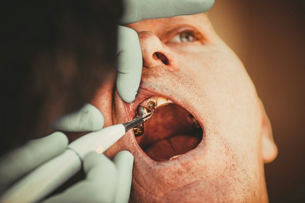Remplacer vos dents manquantes : solutions d'implants à Granby